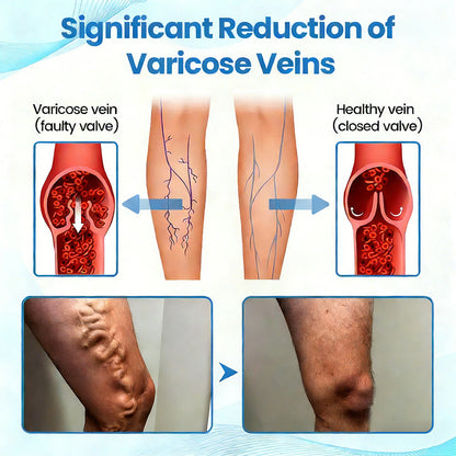 🇬🇧✅✅GFOUK® VascuCare Vein Healing Spray(Designed for Varicose veins, Spider veins, Deep vein Thrombosis, Chronic venous insufficiency, Venous ulcers, Thrombophlebitis and other venous issues)