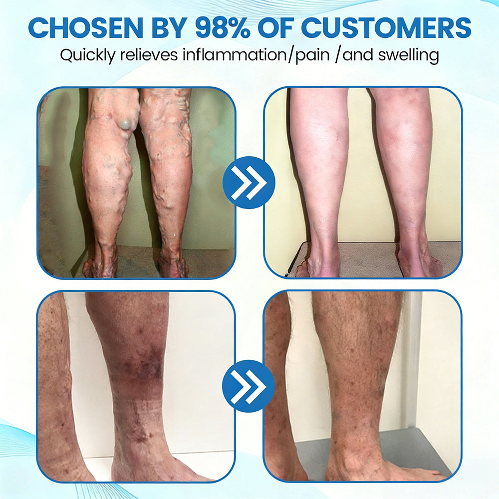 🇬🇧✅✅GFOUK® VascuCare Vein Healing Spray(Designed for Varicose veins, Spider veins, Deep vein Thrombosis, Chronic venous insufficiency, Venous ulcers, Thrombophlebitis and other venous issues)