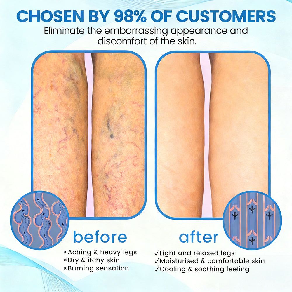 🇬🇧✅✅GFOUK® VascuCare Vein Healing Spray(Designed for Varicose veins, Spider veins, Deep vein Thrombosis, Chronic venous insufficiency, Venous ulcers, Thrombophlebitis and other venous issues)