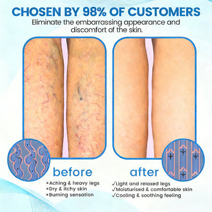 🇬🇧✅✅GFOUK® VascuCare Vein Healing Spray(Designed for Varicose veins, Spider veins, Deep vein Thrombosis, Chronic venous insufficiency, Venous ulcers, Thrombophlebitis and other venous issues)