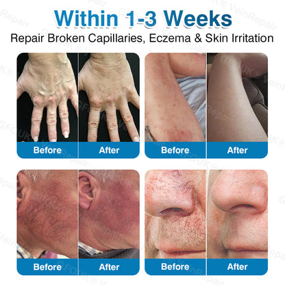 🇬🇧🏆✅️🏃GFOUK® VeinRepair Microneedle Patch Roll⚡Instant Relief, Long-Term Results