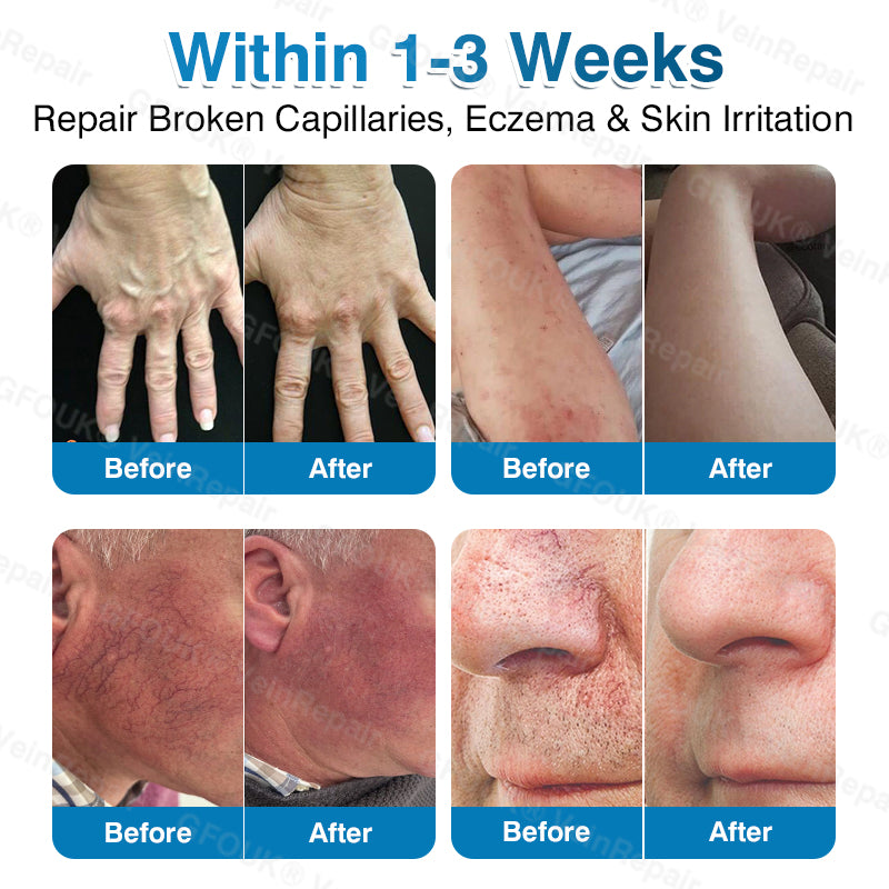 🇬🇧👨‍⚕️👨‍⚕️✅GFOUK® VeinRepair Microneedle Patch Roll⚡Instant Relief, Long-Term Results