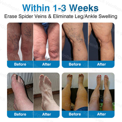 🇬🇧🏆✅️🏃GFOUK® VeinRepair Microneedle Patch Roll⚡Instant Relief, Long-Term Results