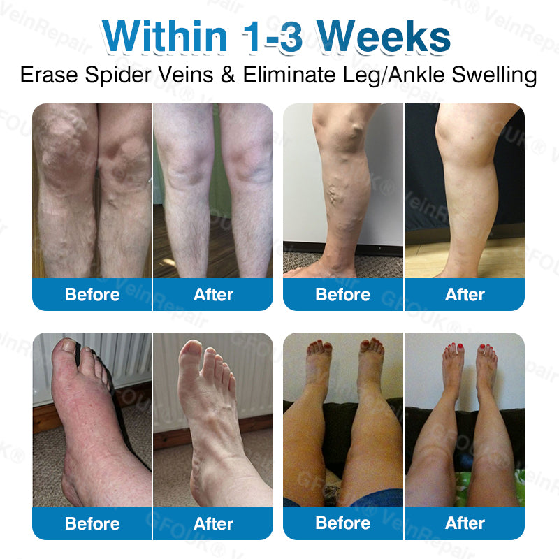 🇬🇧✅GFOUK® VeinRepair Microneedle Patch Roll⚡Instant Relief, Long-Term Results