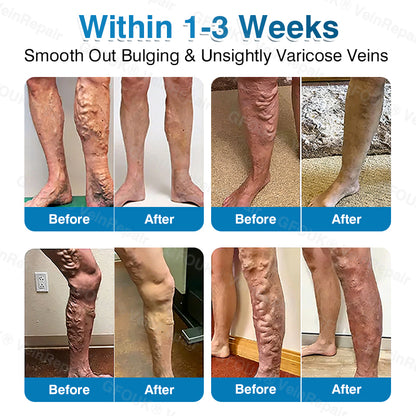 🇬🇧👨‍⚕️👨‍⚕️✅GFOUK® VeinRepair Microneedle Patch Roll⚡Instant Relief, Long-Term Results