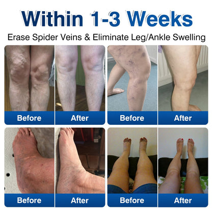uk🎁GFOUK® VeinRenew Microneedle Balm
