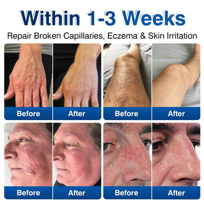 uk🎁GFOUK® VeinRenew Microneedle Balm