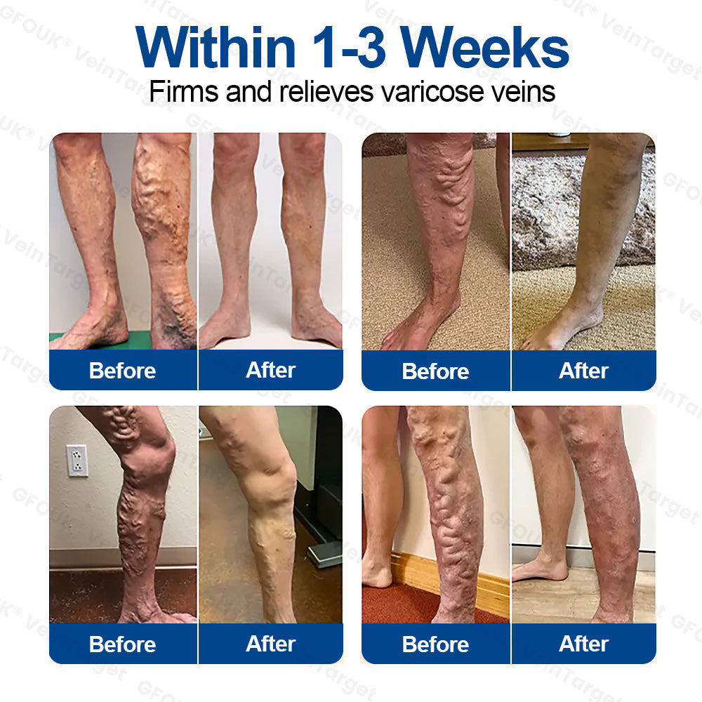 🇬🇧💙👨‍⚕️✅GFOUK® VeinTarget Microneedle Patch⚡Instant Relief, Long-Term Results