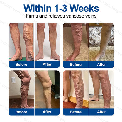🇬🇧💙👨‍⚕️✅GFOUK® VeinTarget Microneedle Patch⚡Instant Relief, Long-Term Results